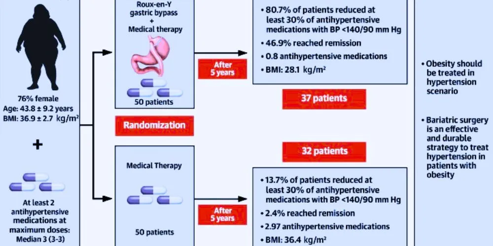 Study Shows Bariatric Surgery Outperforms Medication Alone in Controlling Hypertension